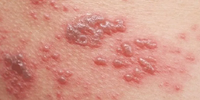 benh-zona-than-kinh-la-benh-gi