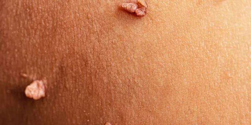 cac-loai-mun-coc-pho-bien