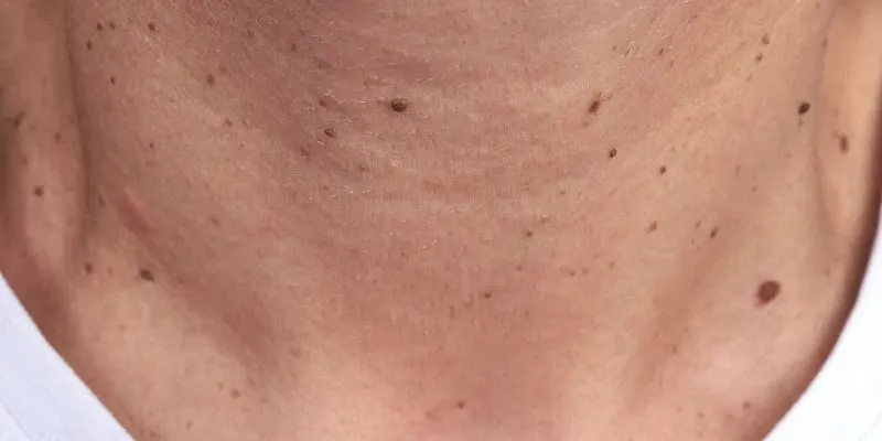 nguyen-nhan-gay-mun-coc