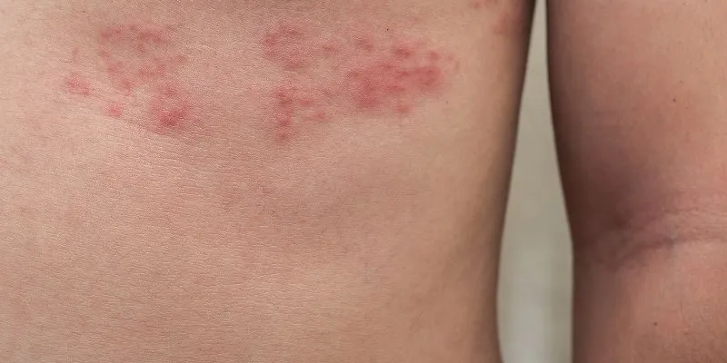 nguyen-nhan-gay-nen-benh-zona-than-kinh